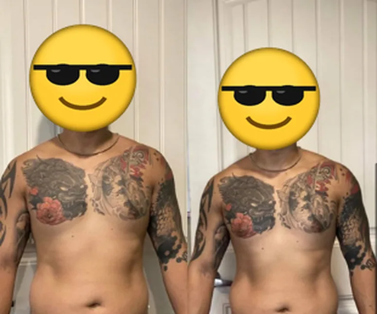 Front view before and after photos of a client, face covered with an emoji.